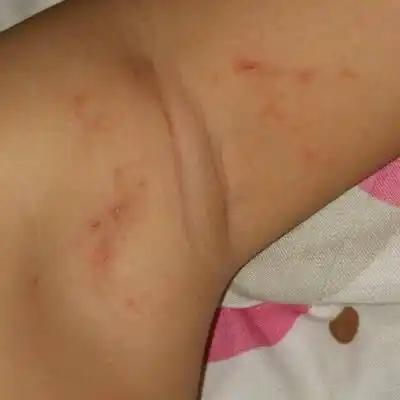 宝宝 腋下长了好多一颗一颗的小痘痘是怎麼回事